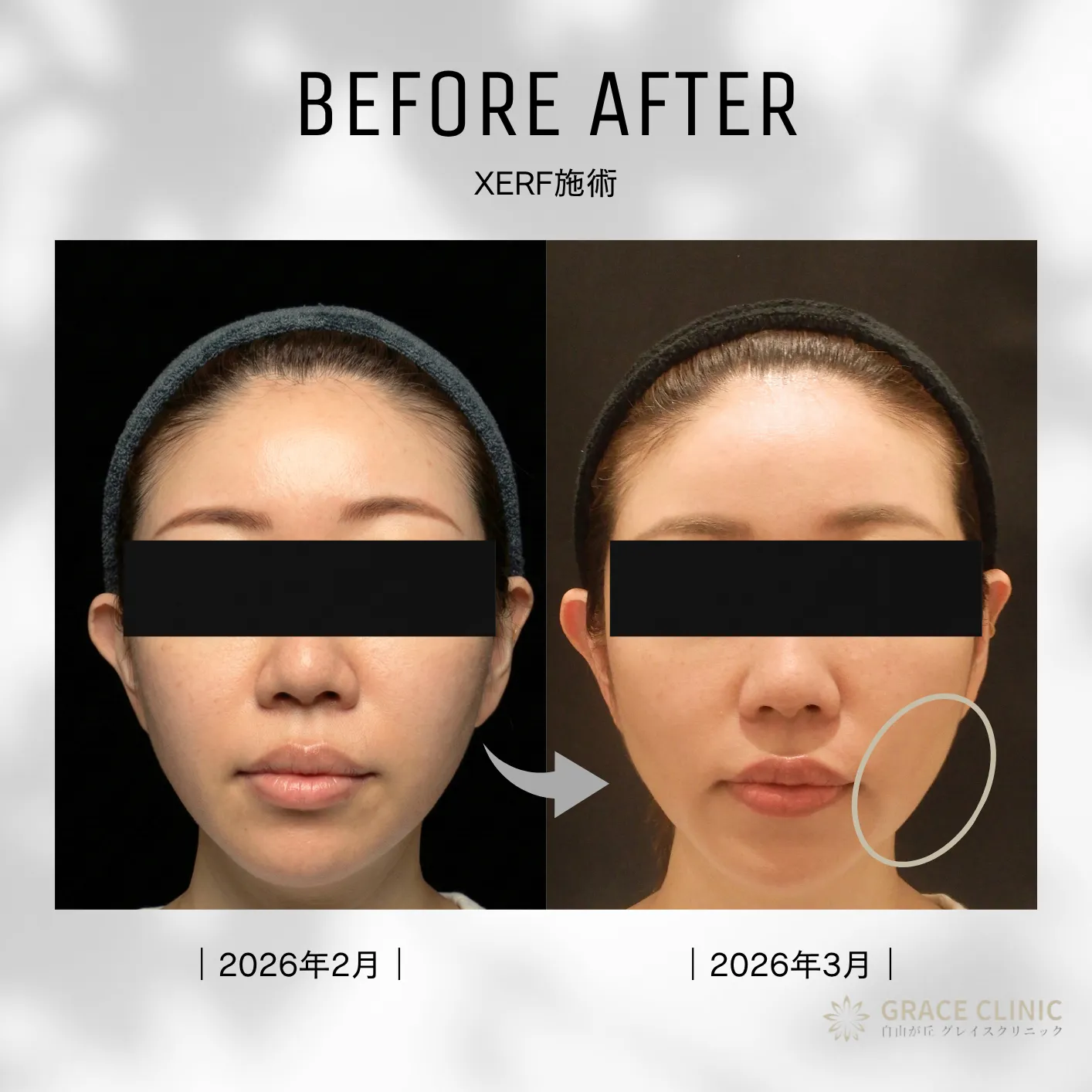 XERF（ザーフ）施術のビフォーアフター症例写真（正面）。ほうれい線やフェイスラインのもたつきが改善し、スッキリとした印象に変化しています。