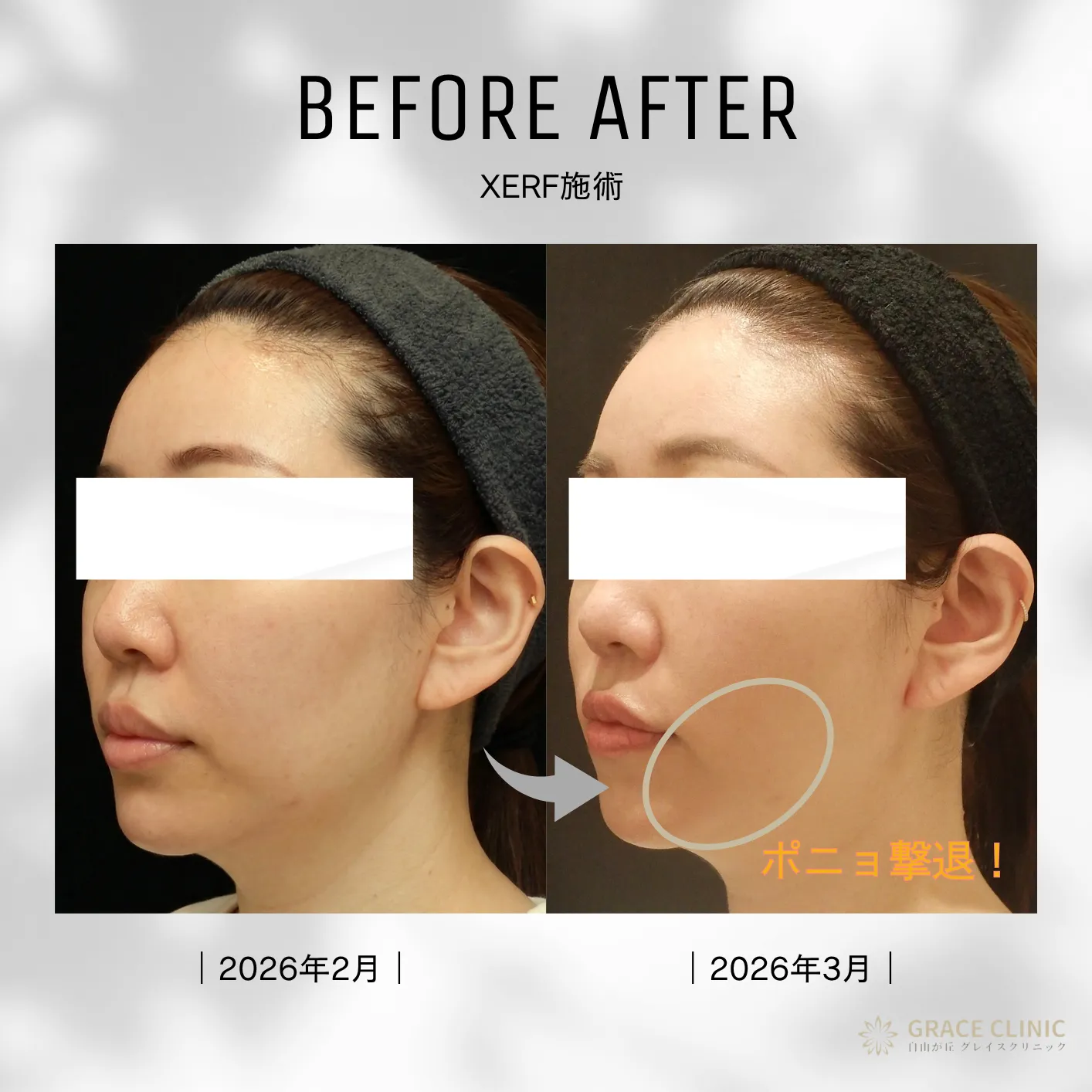 XERF（ザーフ）施術のビフォーアフター症例写真（斜め）。口横のふくらみ（ポニョ）が解消され、シャープなフェイスラインに改善しています。