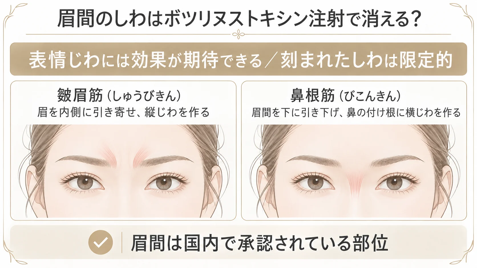 眉間のしわをつくる筋肉を示したインフォグラフィック